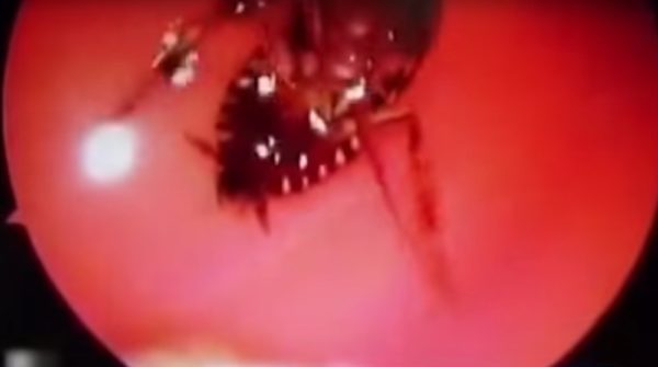 Imagem de endoscópio mostra barata dentro de cabeça de paciente (Foto: Reprodução/YouTube)